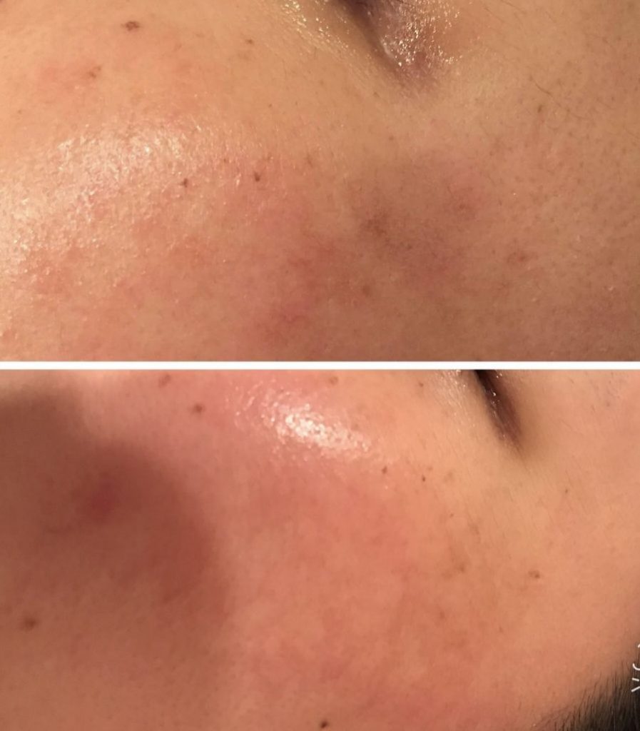 お肌にできたシミあきらめてませんか？毎日のスキンケアでトーンアップは叶います！！　