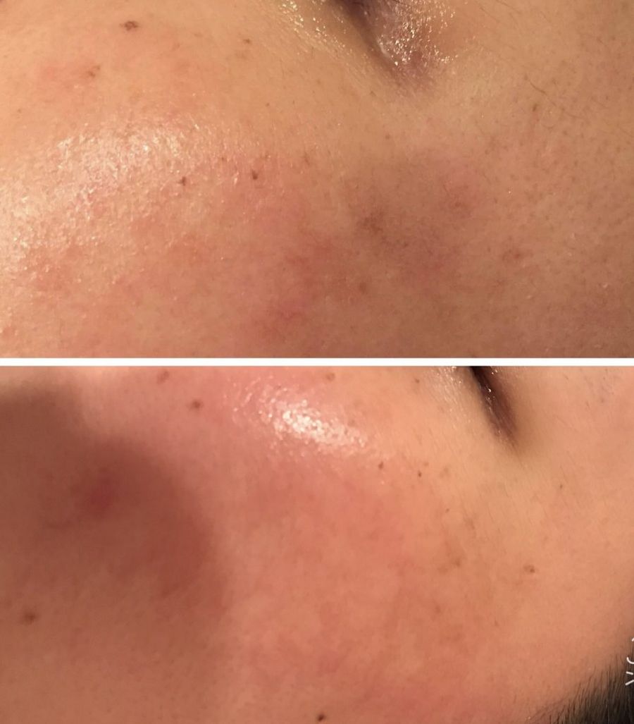 お肌にできたシミあきらめてませんか？毎日のスキンケアでトーンアップは叶います！！　