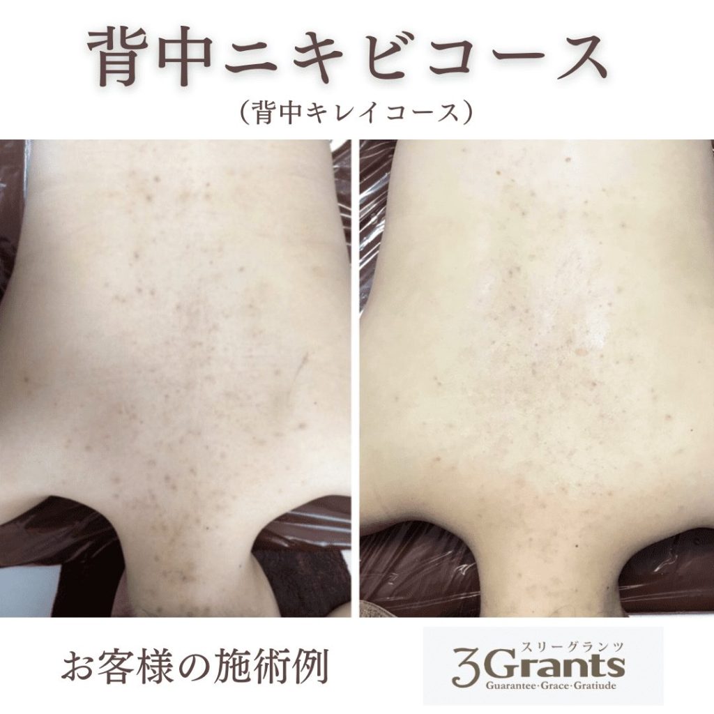 背中ニキビが気になります。キレイになりませんか？