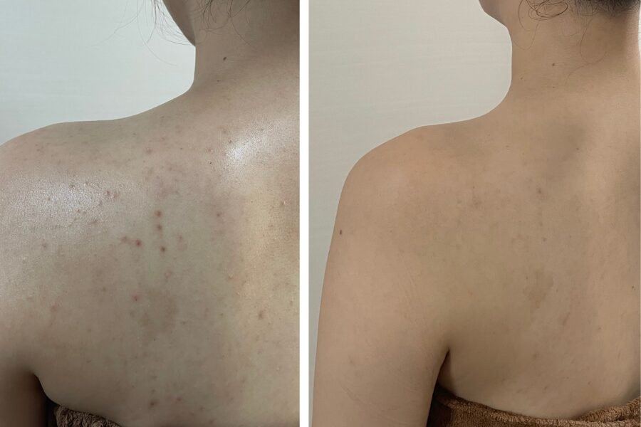 花嫁様のお背中の悩みを解決！〜背中のニキビ跡とぷよ肉対策〜